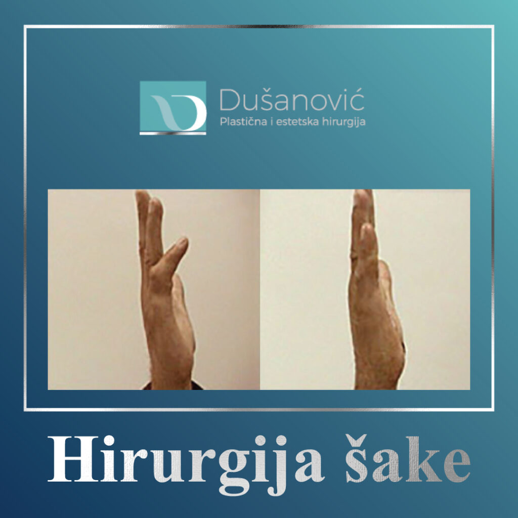 hirurgija sake