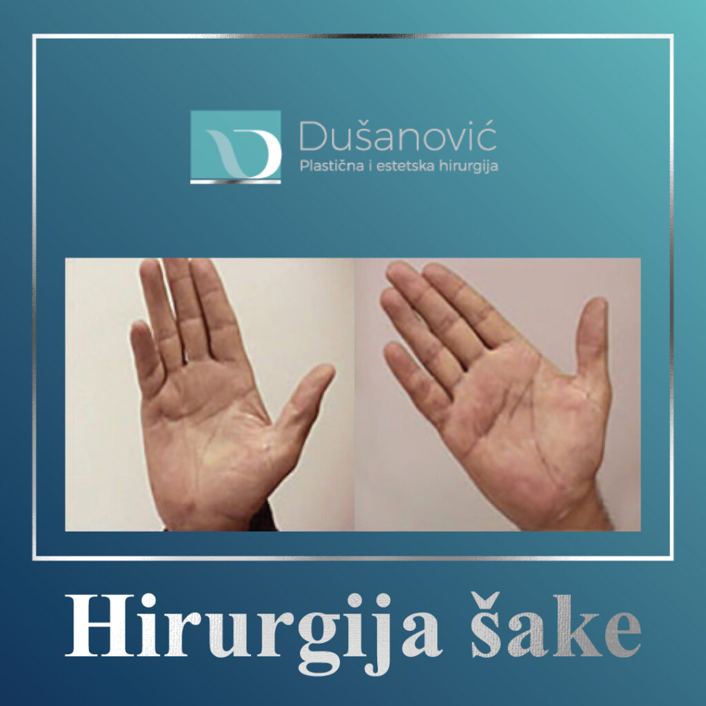 hirurgija sake