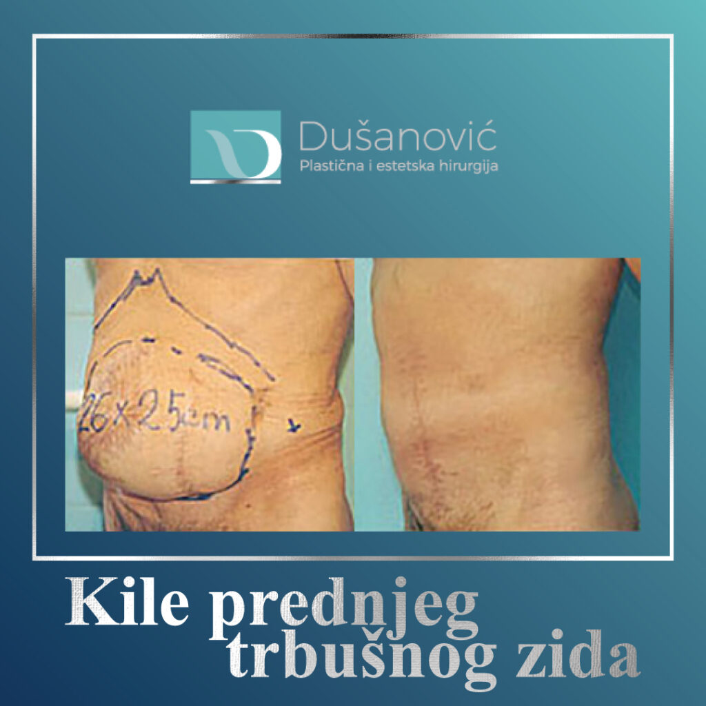 kile prednjeg trbusnog zida