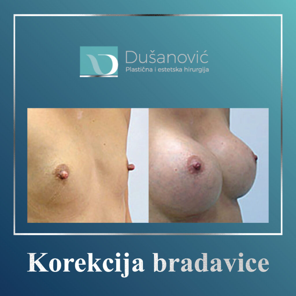 korekcija bradavice dojke