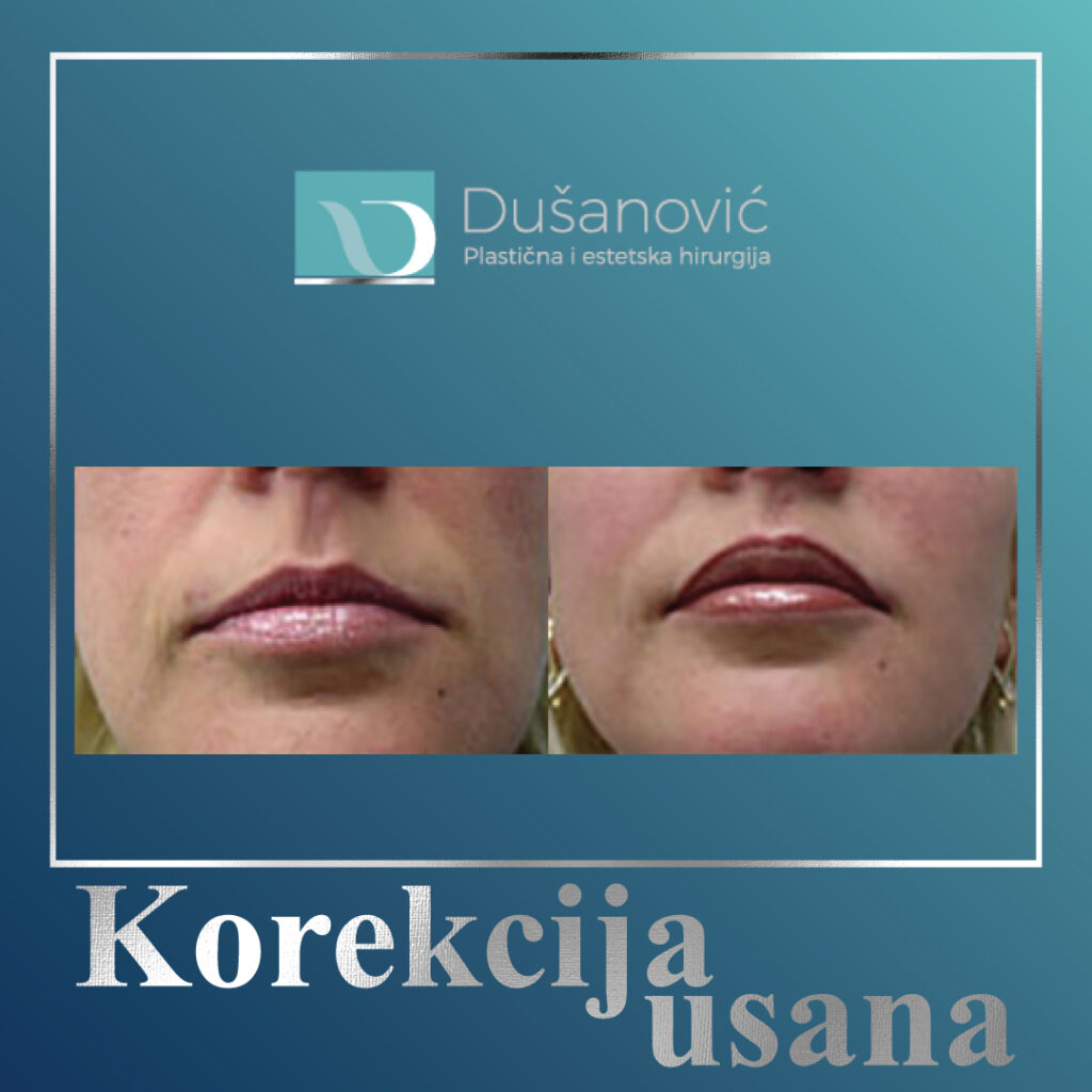 korekcija usana