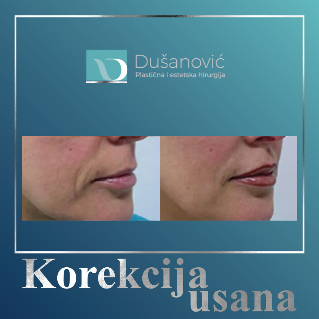 korekcija usana