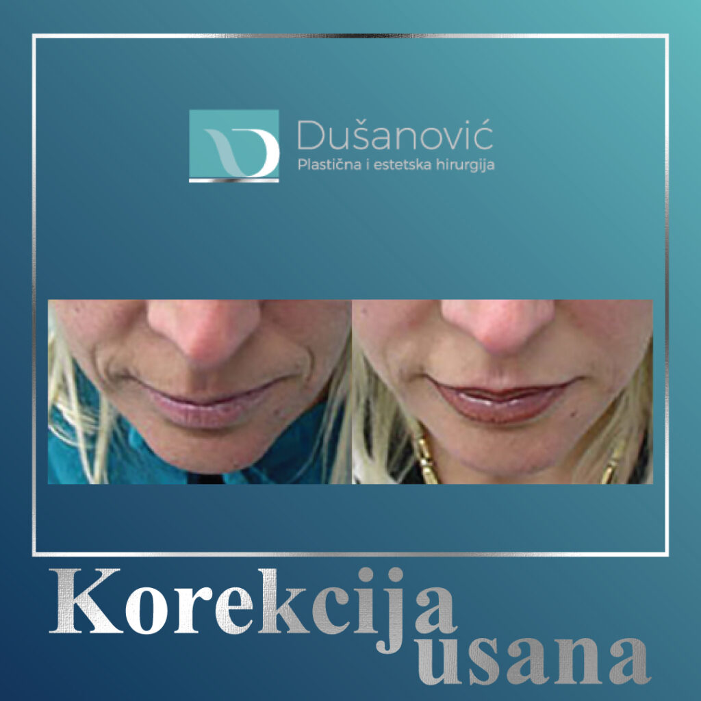 korekcija usana