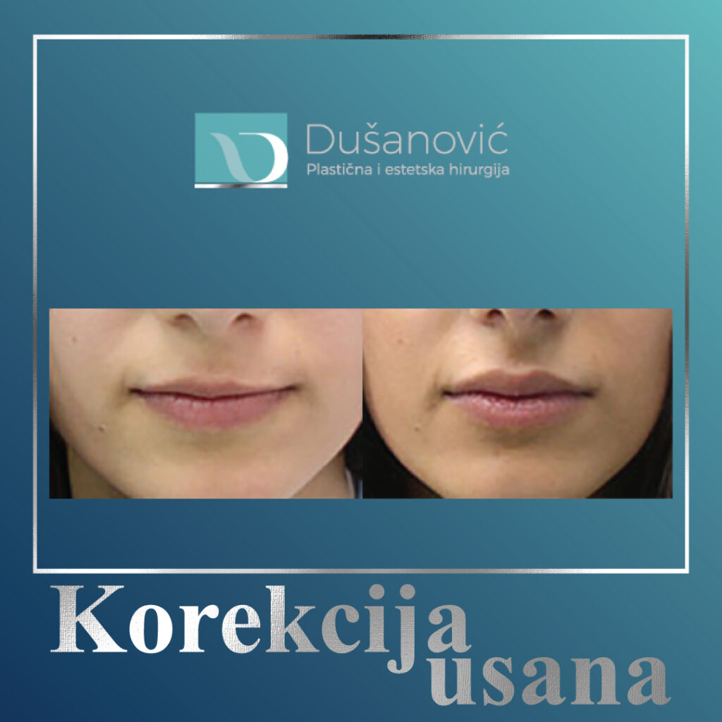 korekcija usana