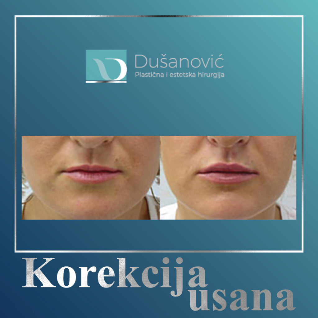 korekcija usana