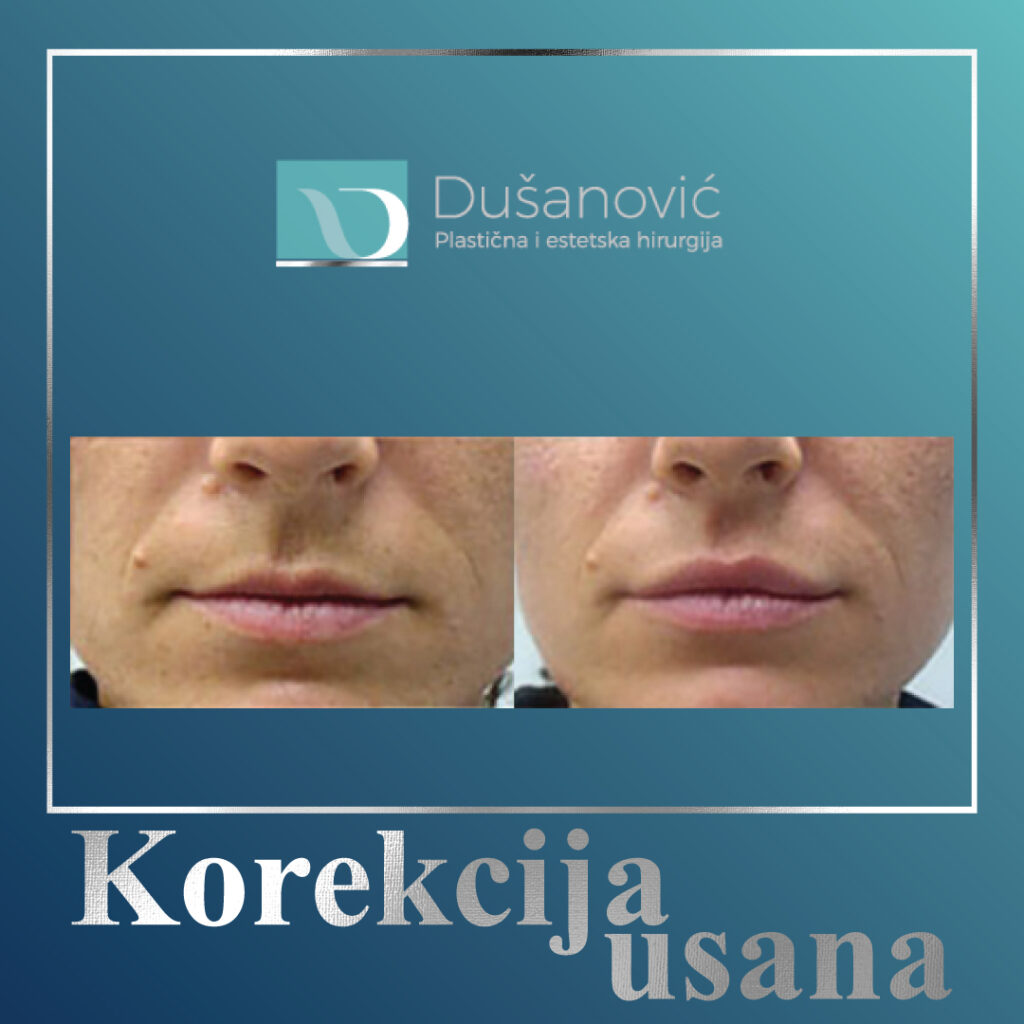 korekcija usana