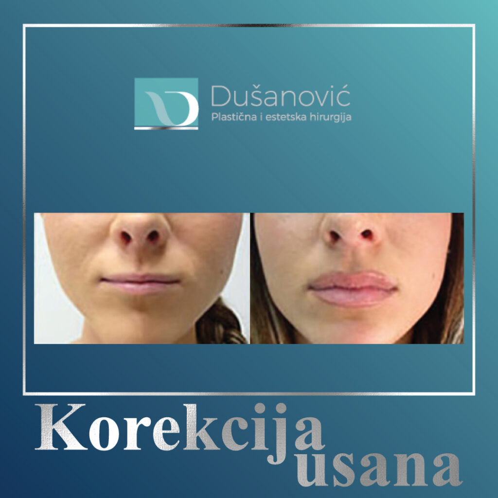 korekcija usana