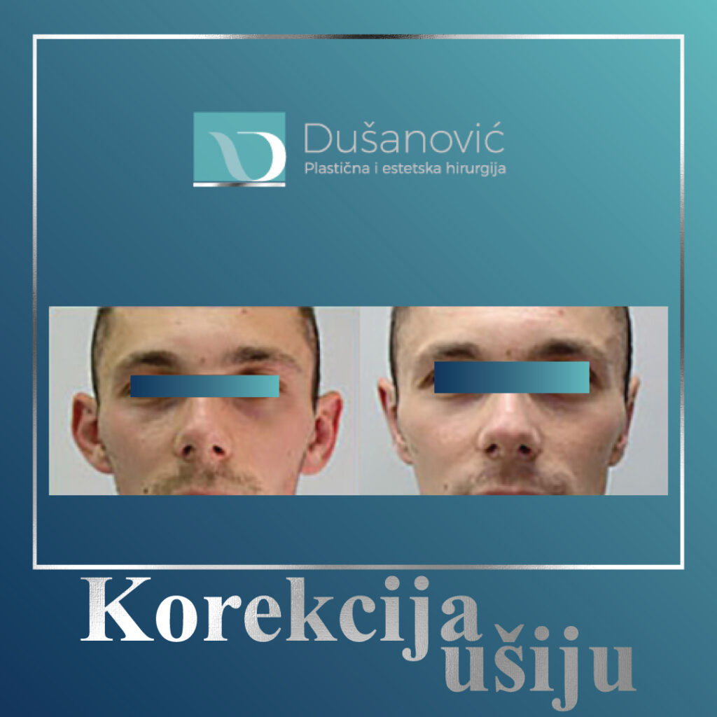 korekcija usiju