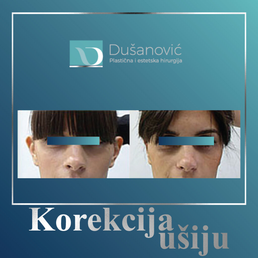 korekcija usiju