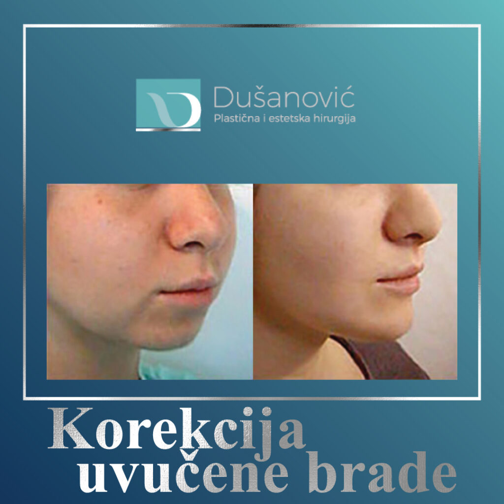 korekcija uvucene brade