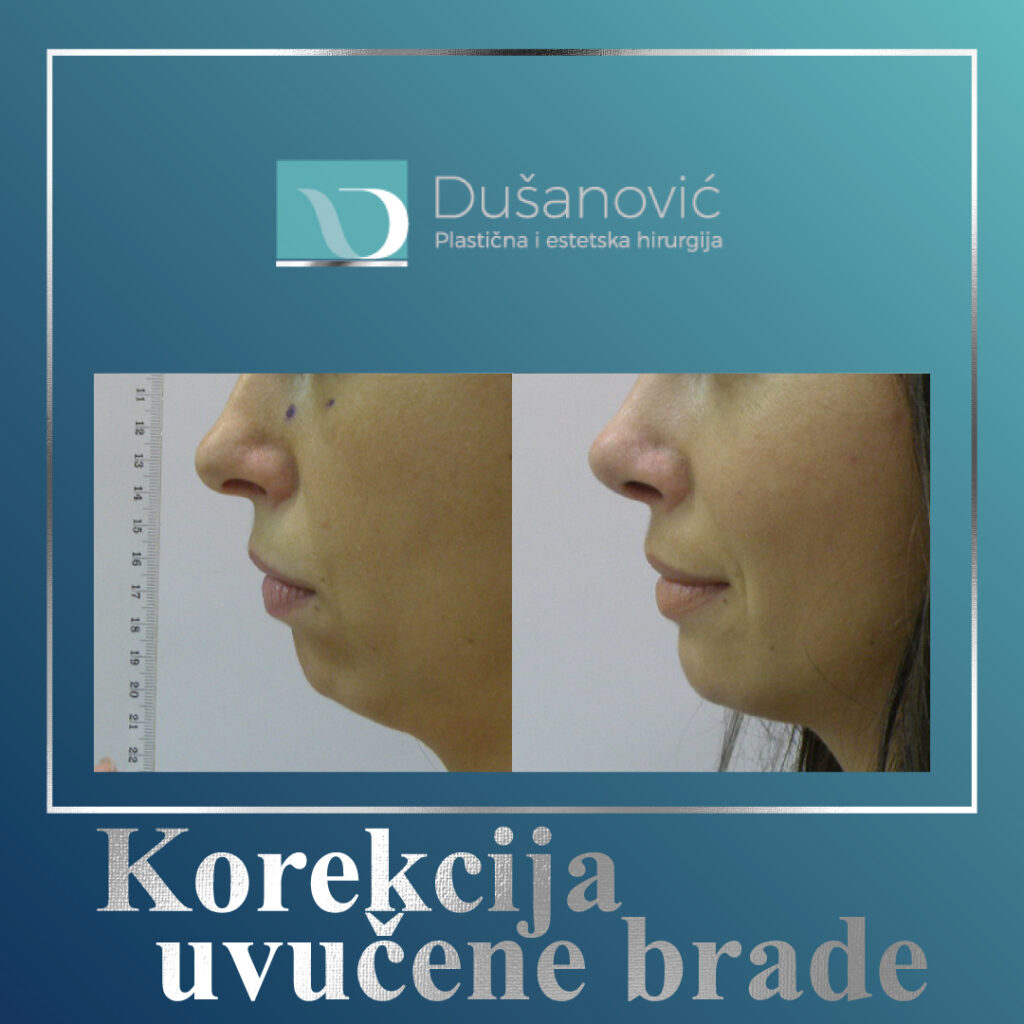 korekcija uvucene brade