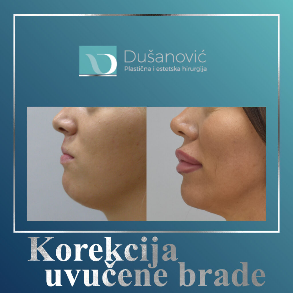 korekcija uvucene brade