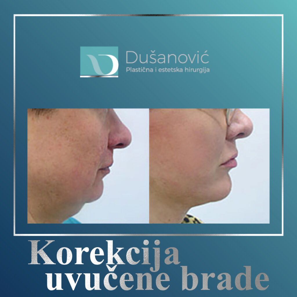 korekcija uvucene brade