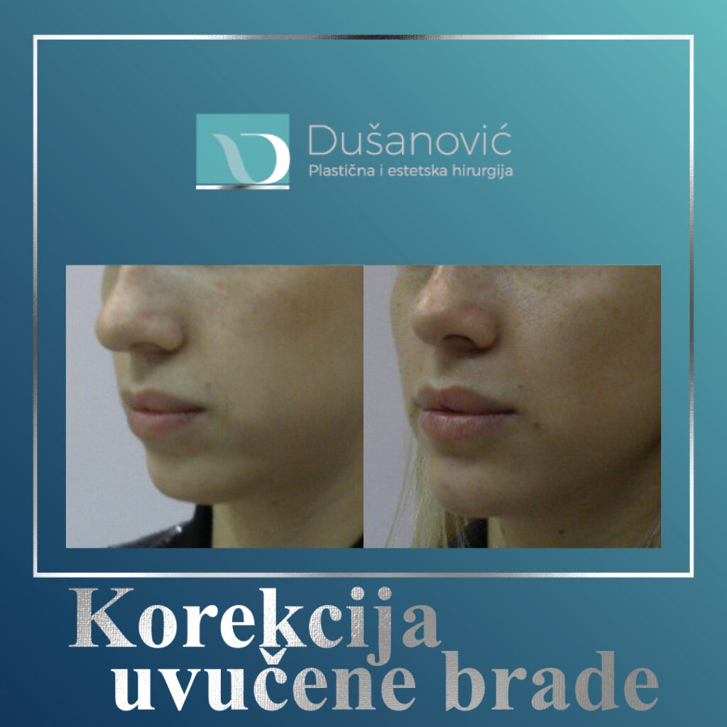 korekcija uvucene brade