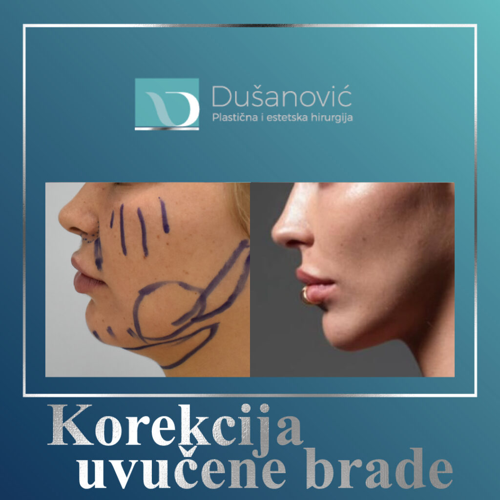 korekcija uvucene brade