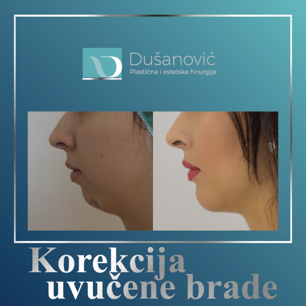 korekcija uvucene brade