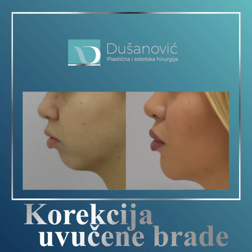 korekcija uvucene brade