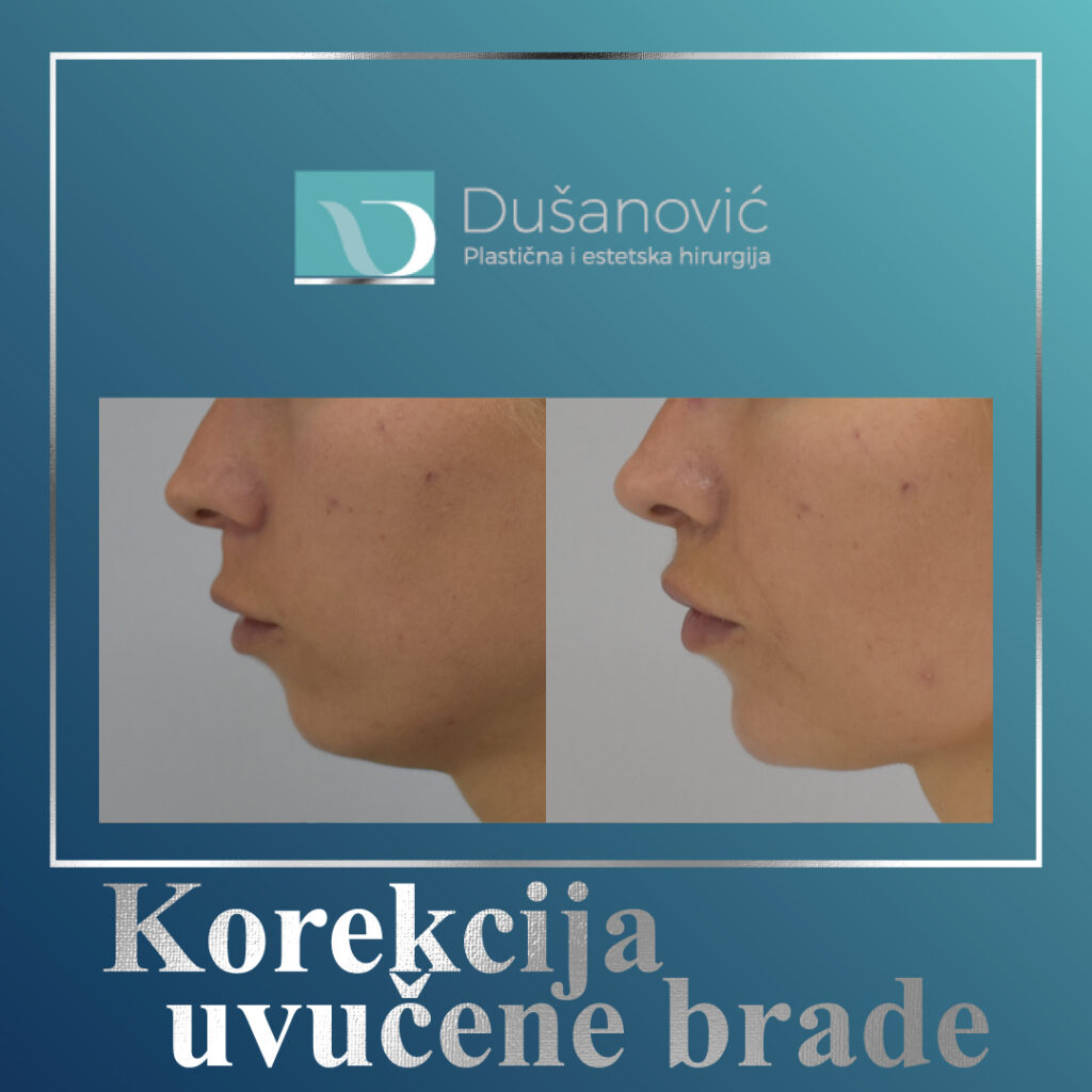 korekcija uvucene brade