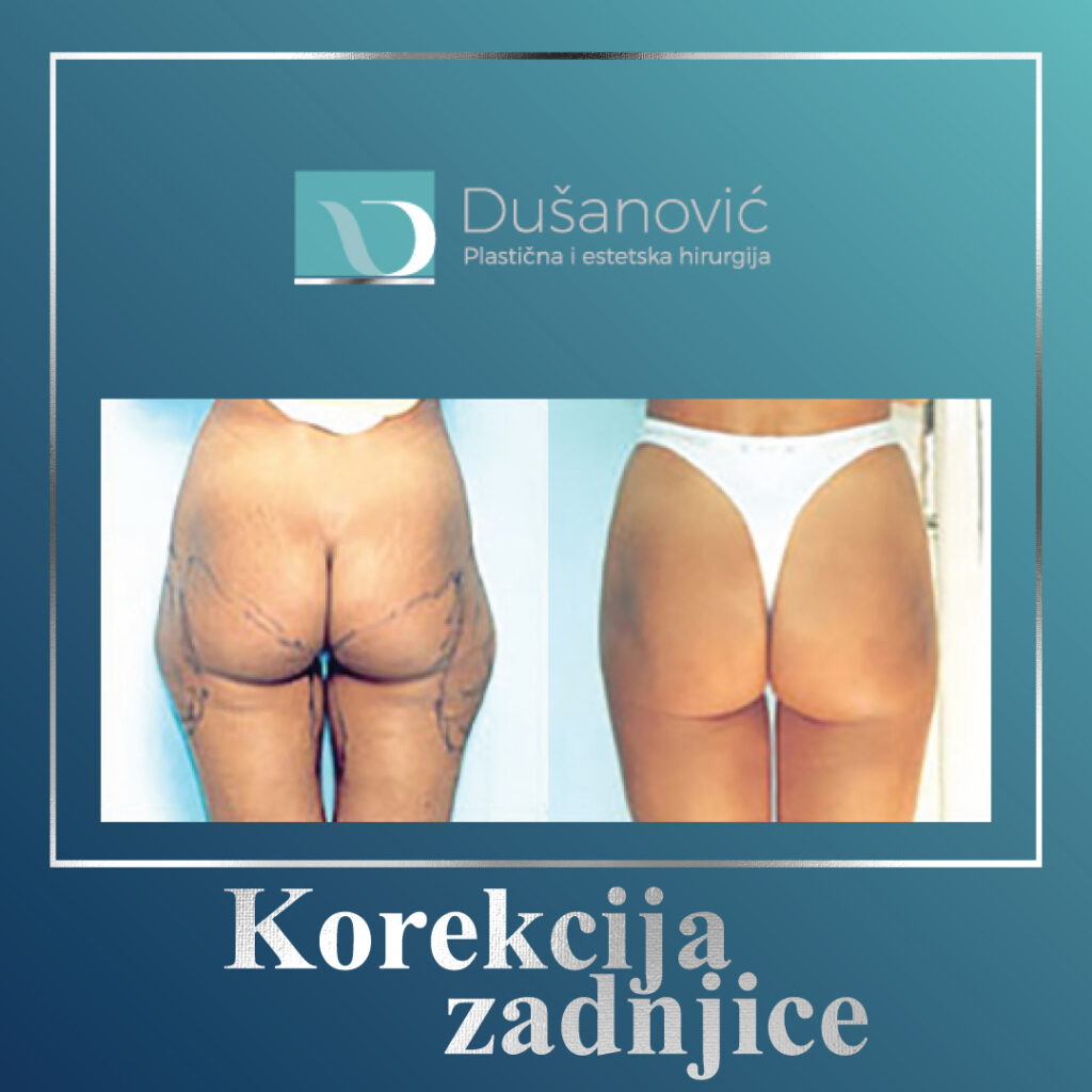 korekcija zadnjice