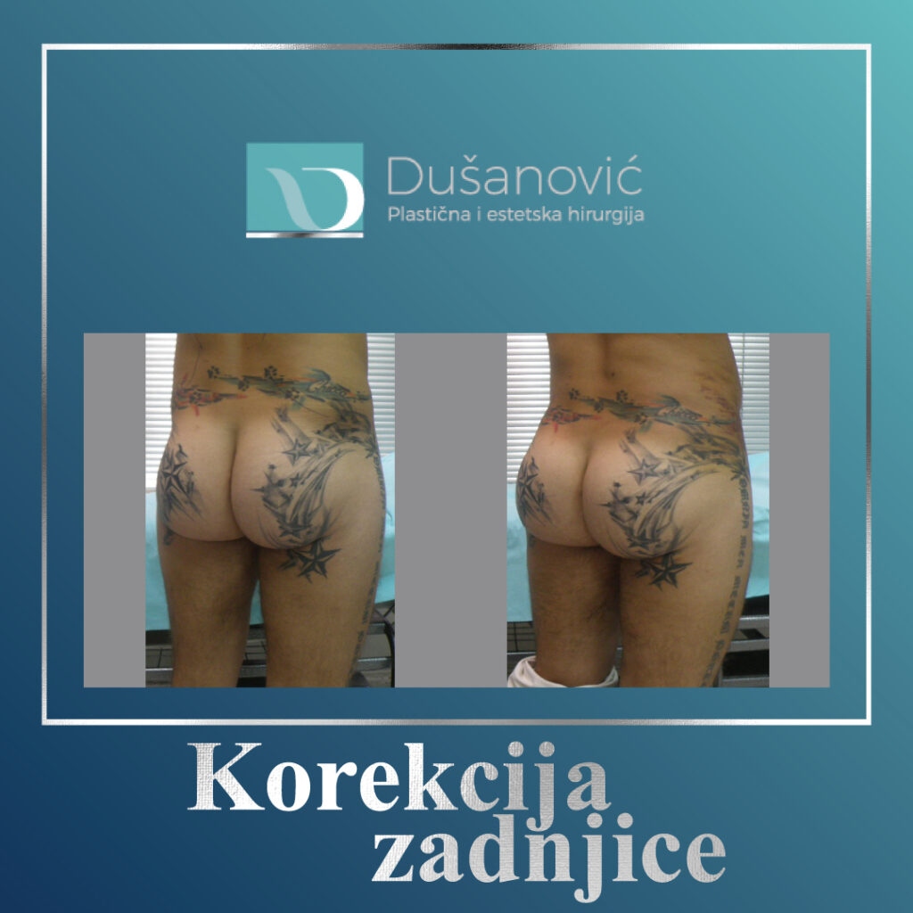 korekcija zadnjice