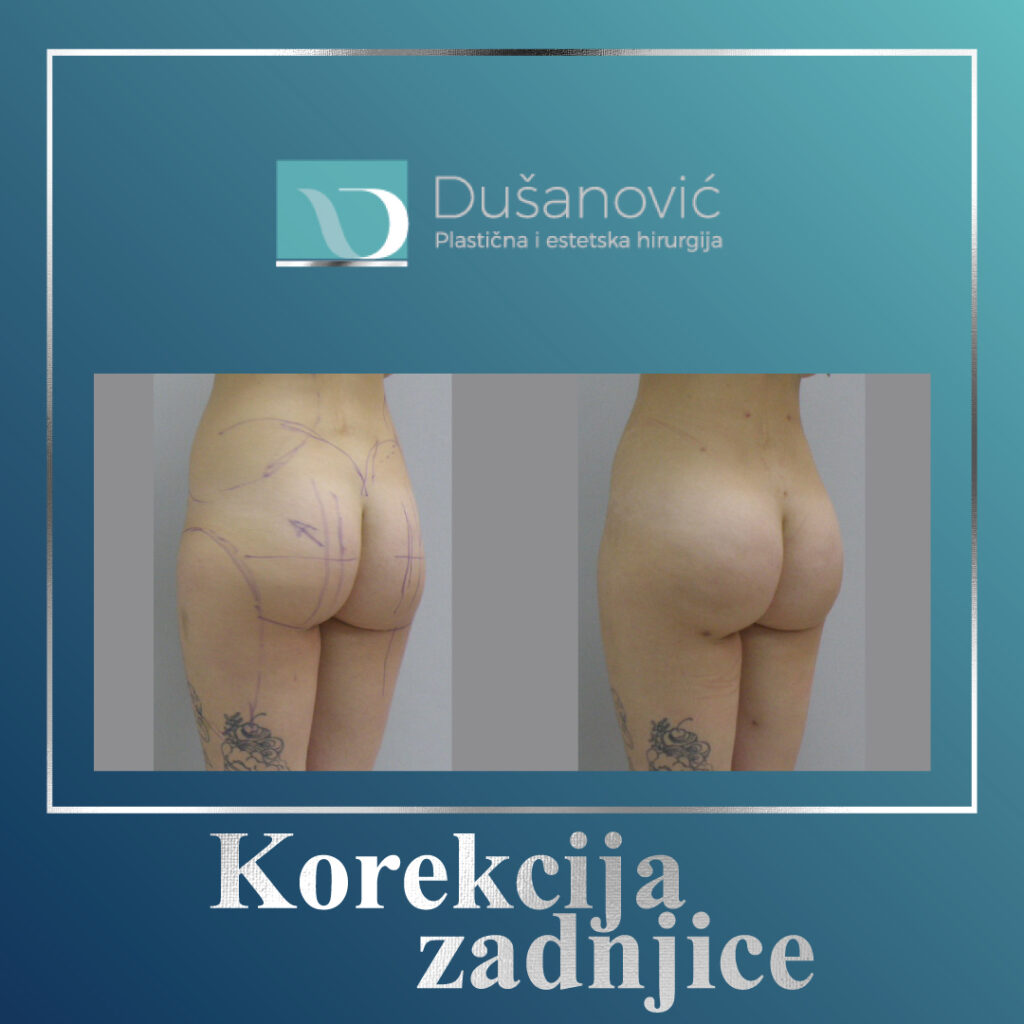 korekcija zadnjice