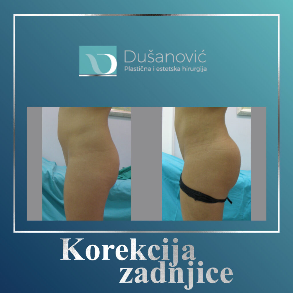 korekcija zadnjice