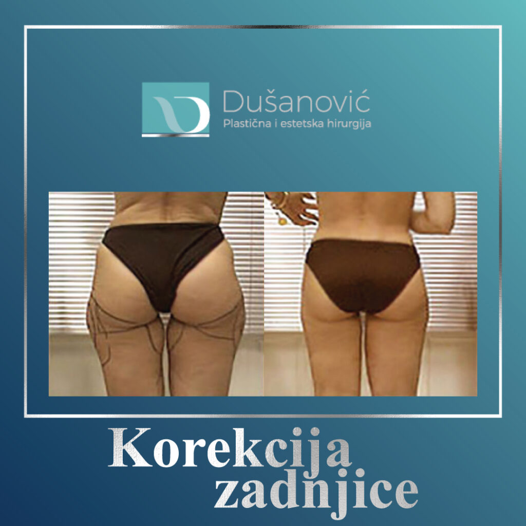 korekcija zadnjice