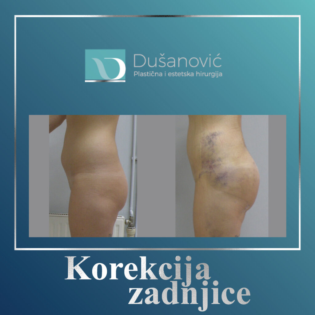 korekcija zadnjice