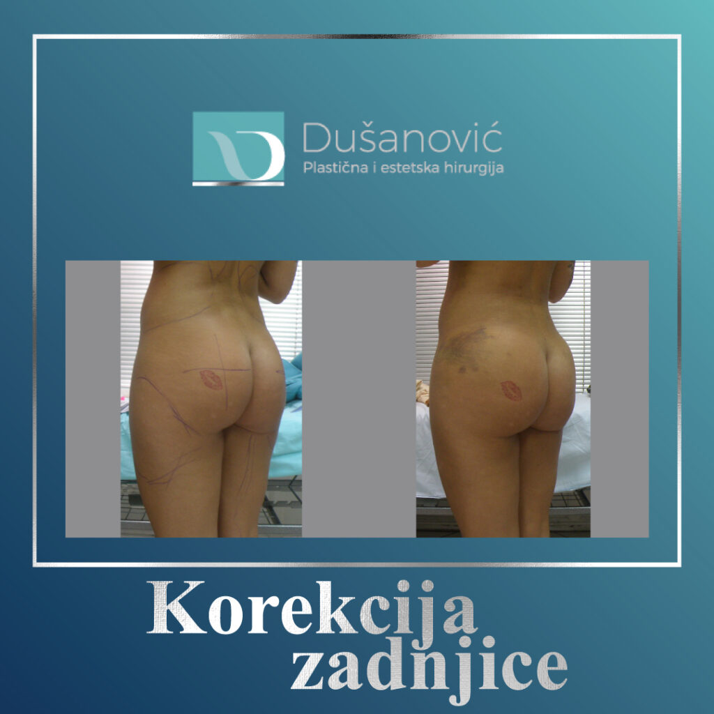 korekcija zadnjice