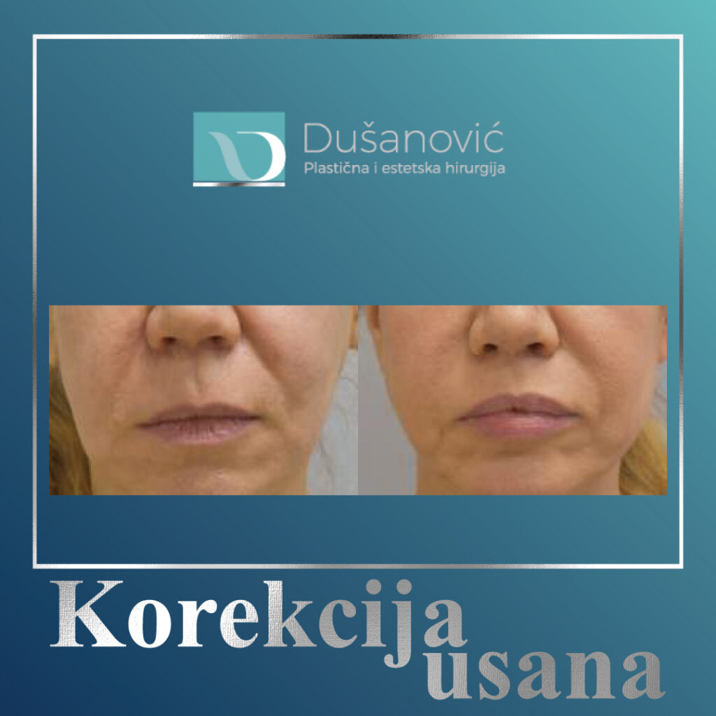 korekcija usana, lip lift