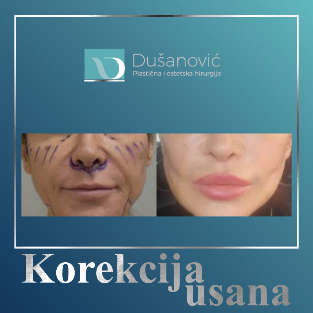 korekcija usana, lip lift