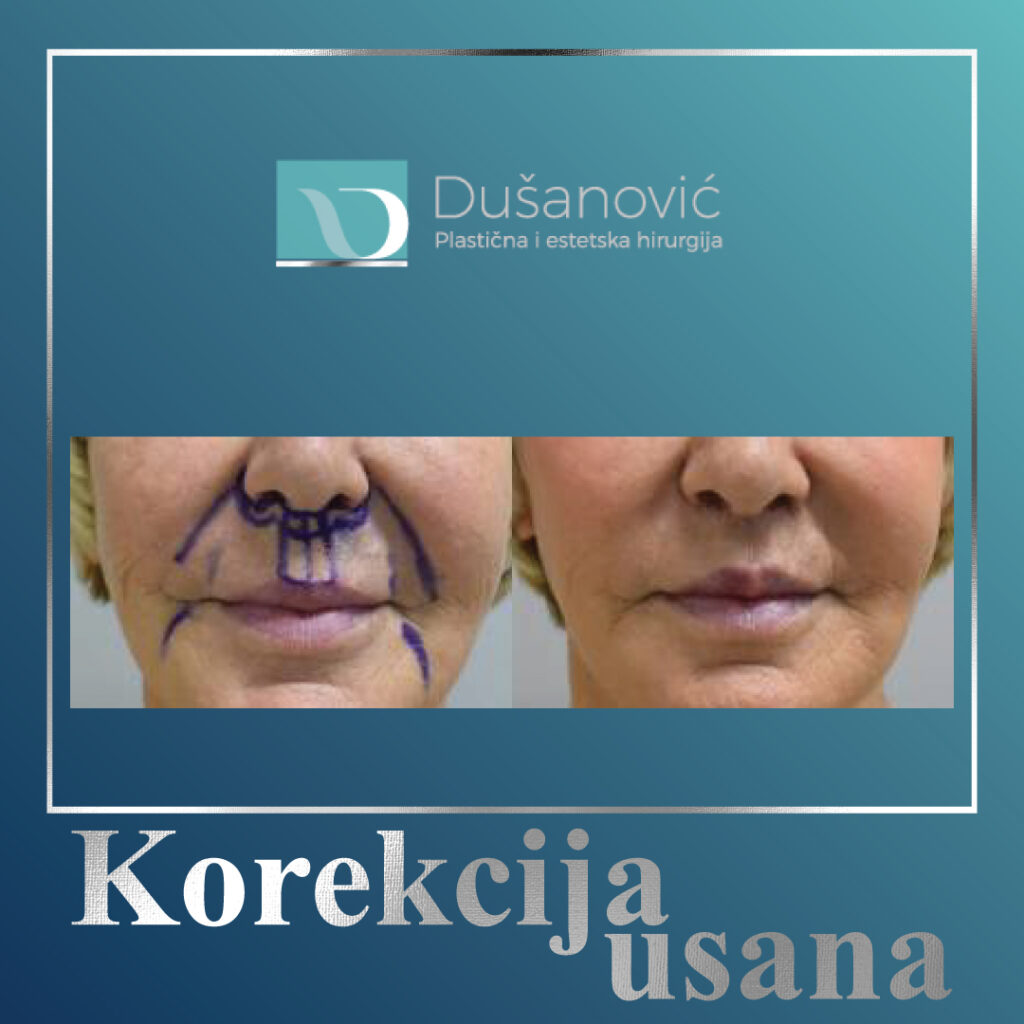korekcija usana, lip lift
