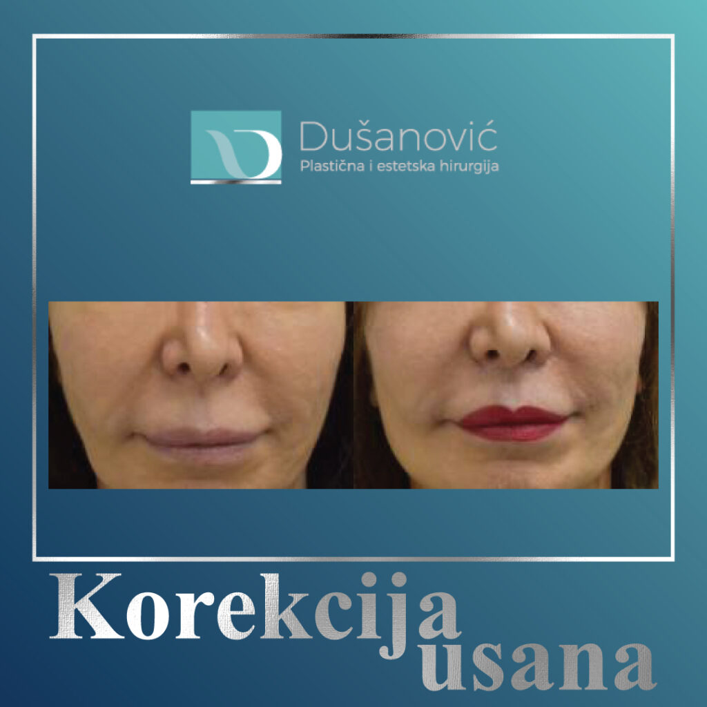 korekcija usana, lip lift