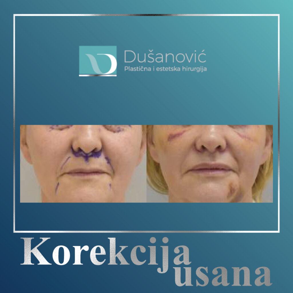 korekcija usana, lip lift