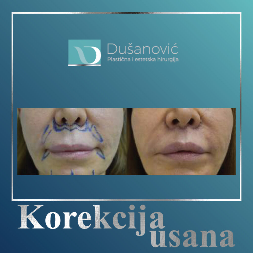korekcija usana, lip lift