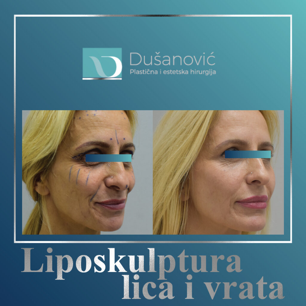 liposkulptura lica i vrata