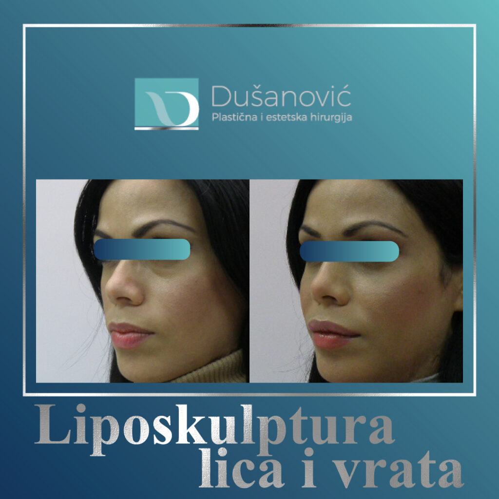 Liposkulptura lica
