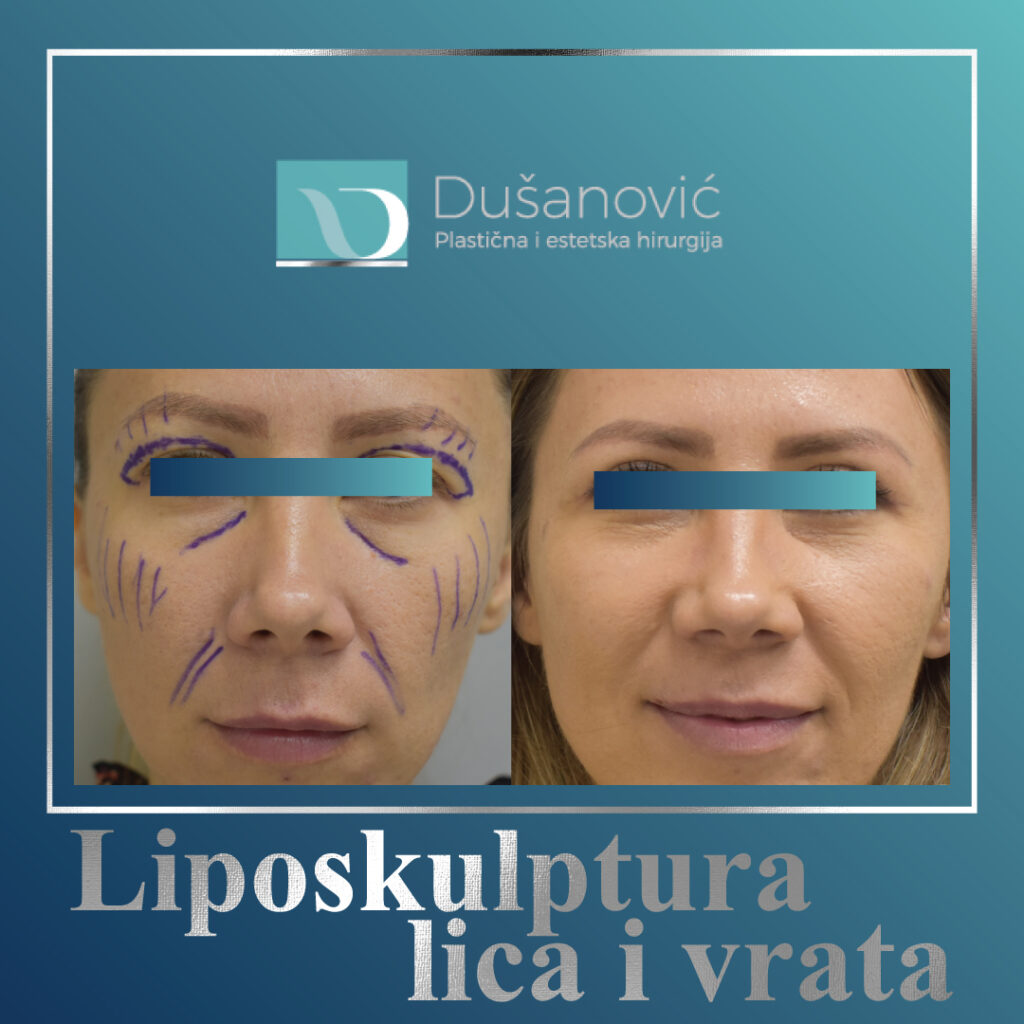 liposkulptura lica i vrata
