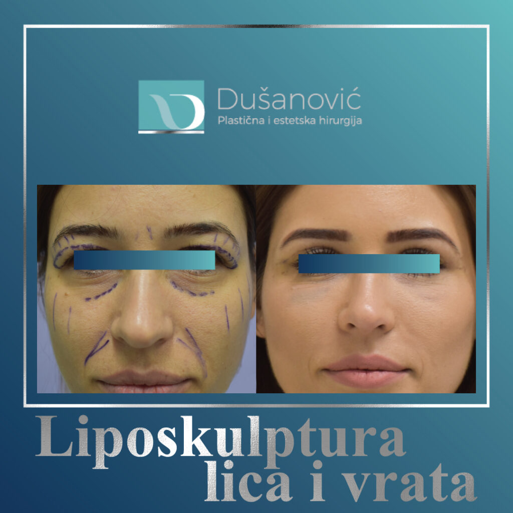 liposkulptura lica i vrata