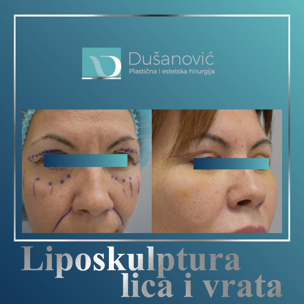 face lifting, zatezanje lica