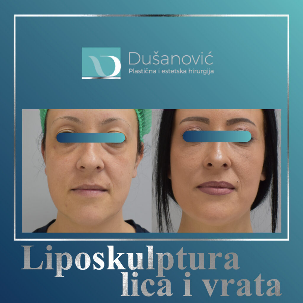 Liposkulptura lica i vrata