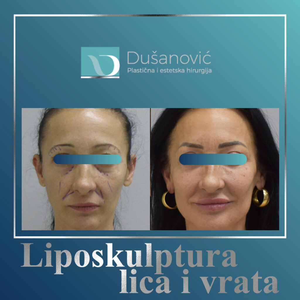 liposkulptura lica