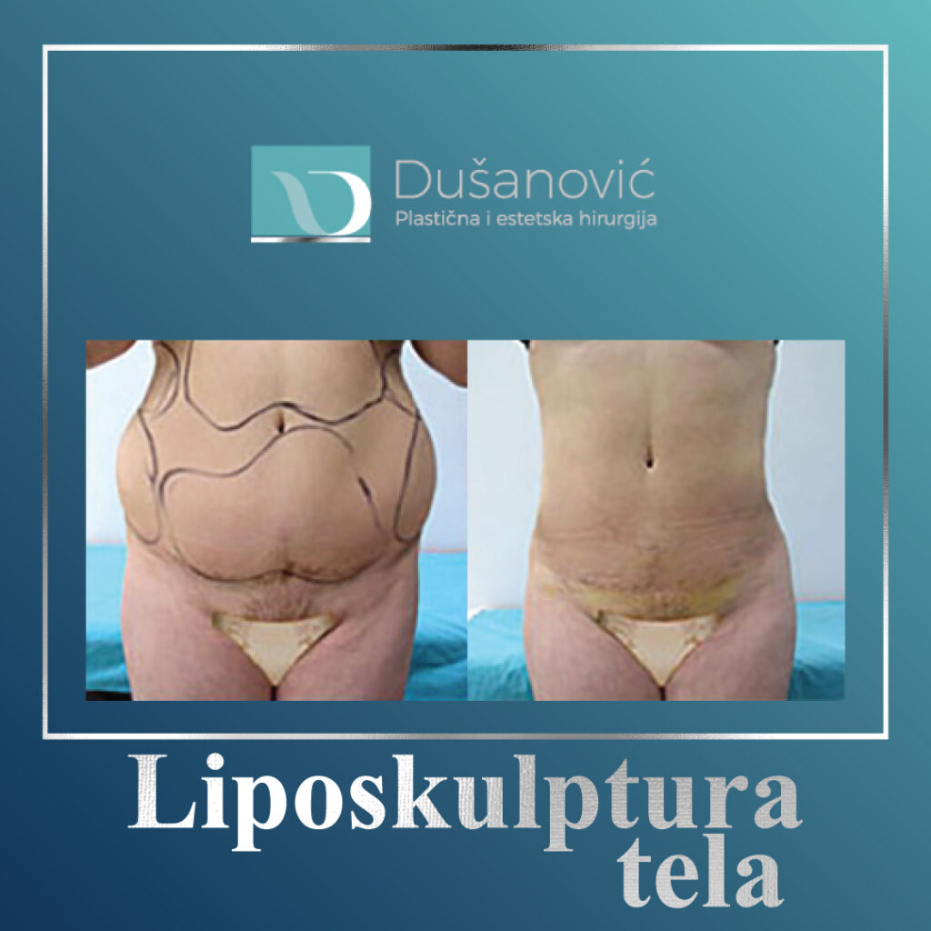 liposkulptura tela