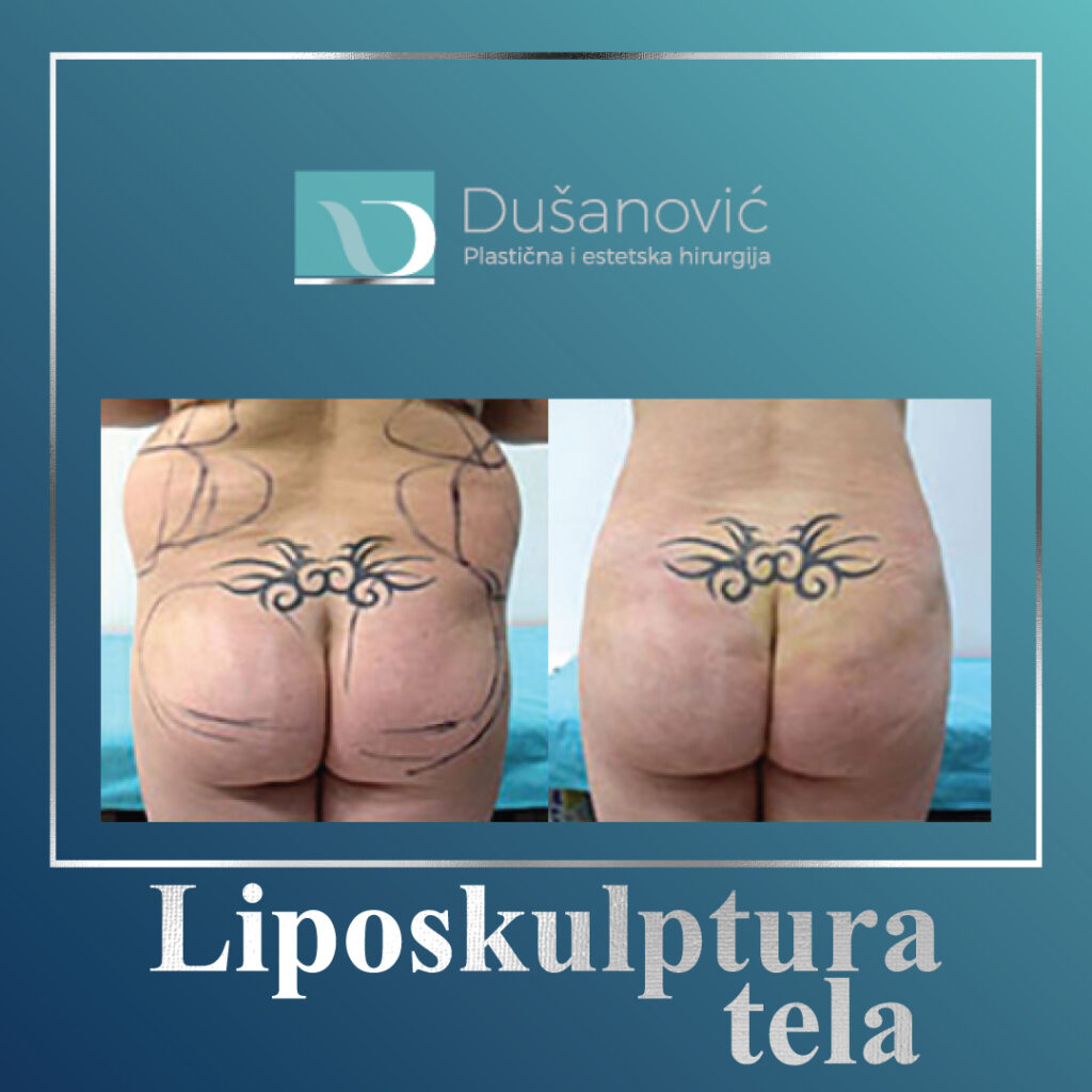 liposkulptura tela