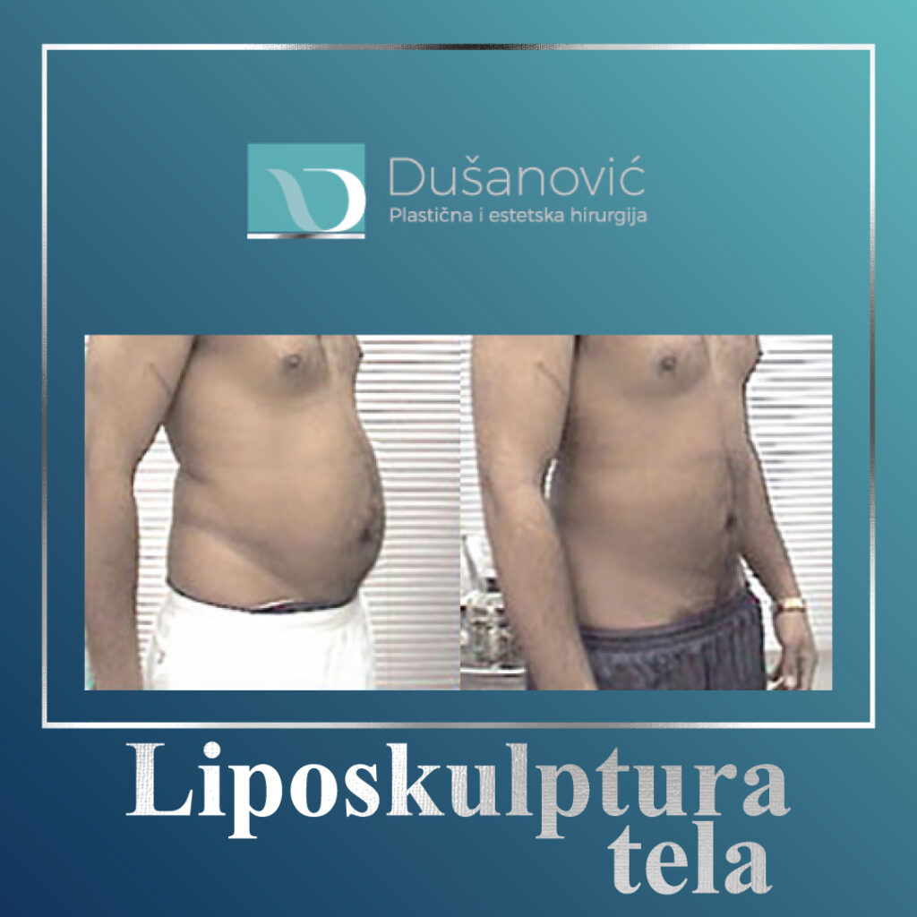 liposkulptura tela