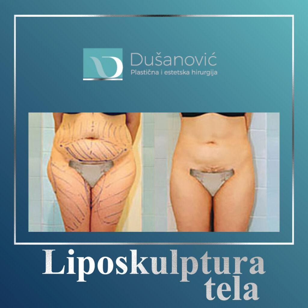 liposkulptura tela