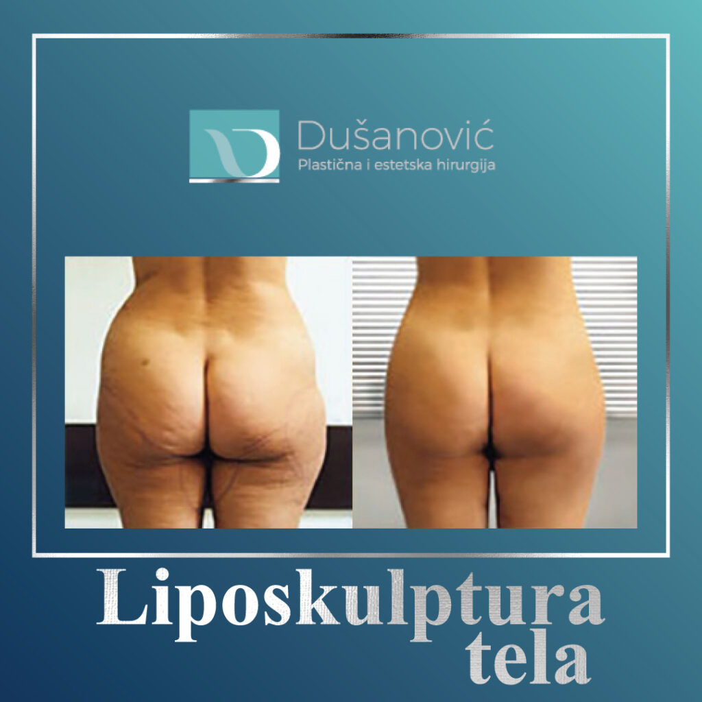 liposkulptura tela
