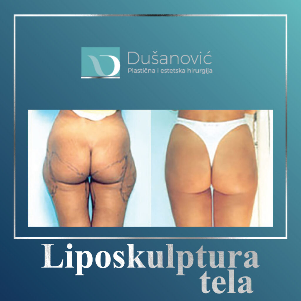 liposkulptura tela