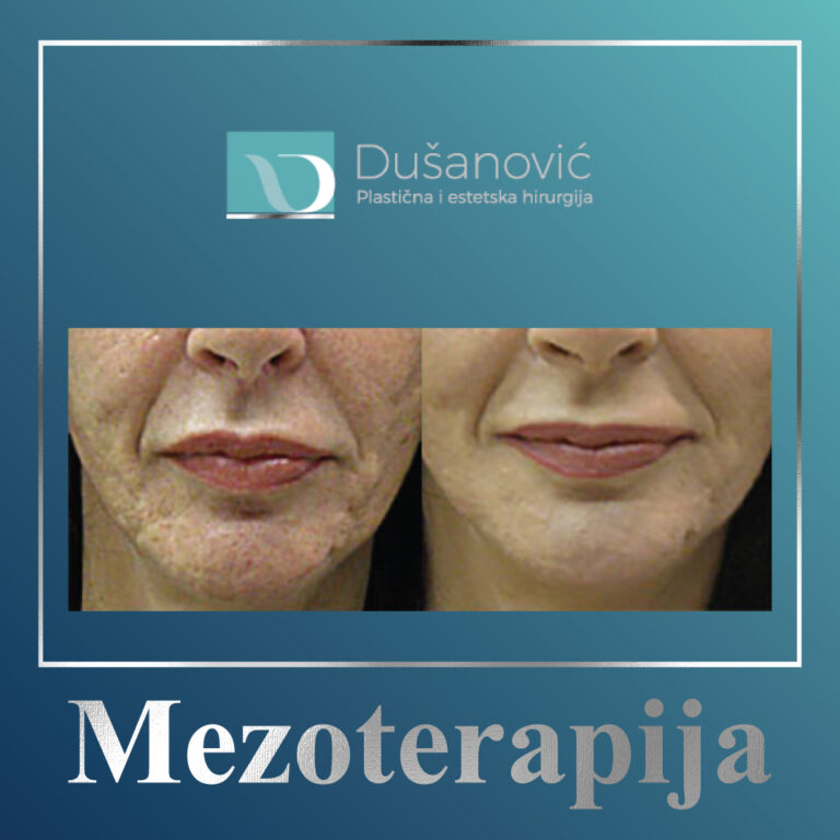mezoterapija
