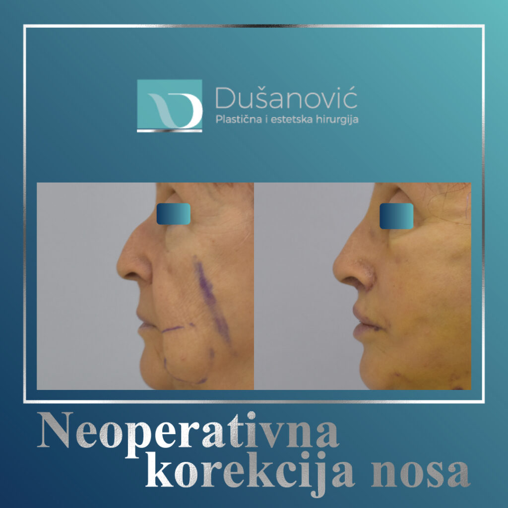 neoperativna korekcija nosa